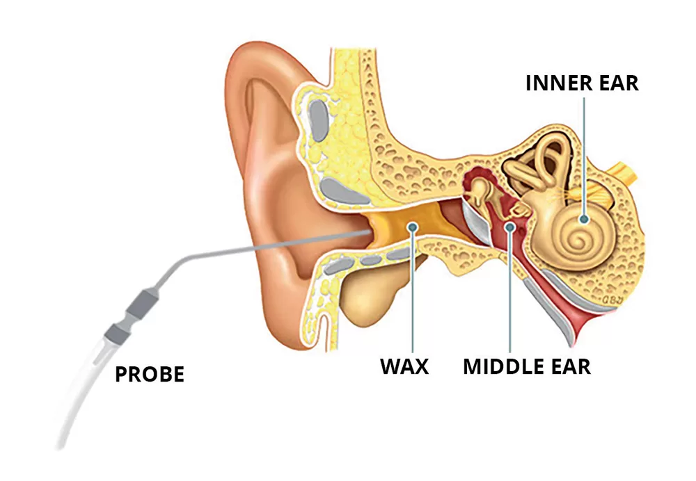 Wax-Removal-independent-hearing