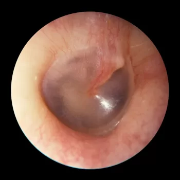 ear wax removal adelaide,earwax removal,ear wax removal,ear cleaning,ear cleaning adelaide